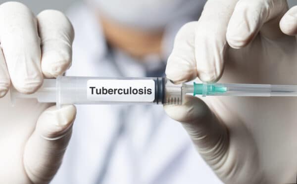 Tuberculosis